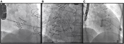 Transcatheter Valve-in-Valve Procedures for Bioprosthetic Valve Dysfunction in Patients With Rheumatic vs. Non-Rheumatic Valvular Heart Disease